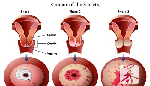 人乳头瘤病毒33型阳性是什么意思