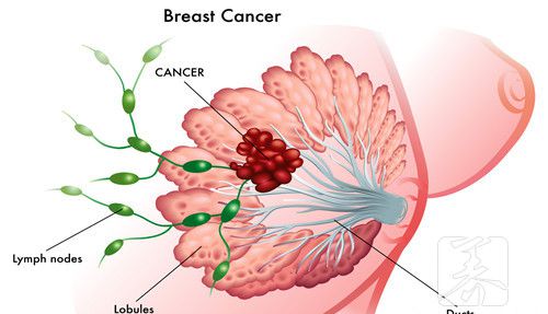 乳腺结节低回声是什么意思