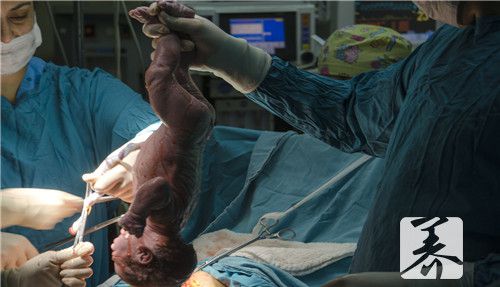孕妇剖腹产10天后死亡