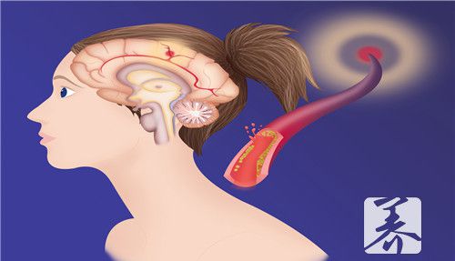 女性脑膜瘤的早期症状