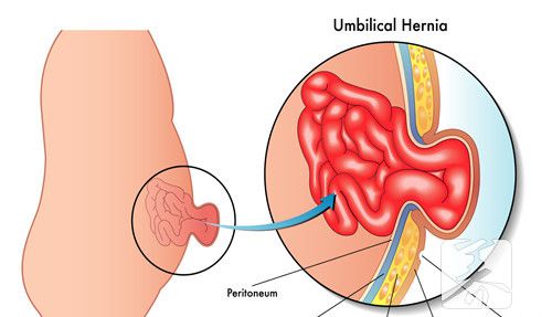 女性腹股沟长包