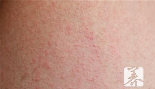 女性大腿根部红点