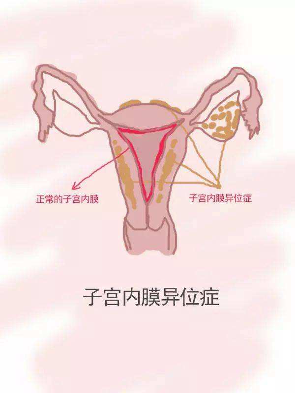 子宫内膜异位症中药灌肠效果好吗？灌肠疗法方法、药方与注意事项