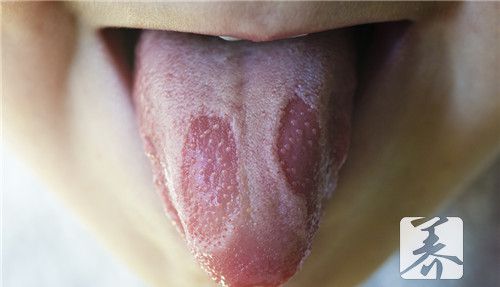 舌头溃疡忌口 7个饮食禁忌