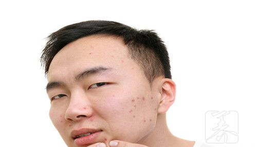 西咪替丁治疗痤疮