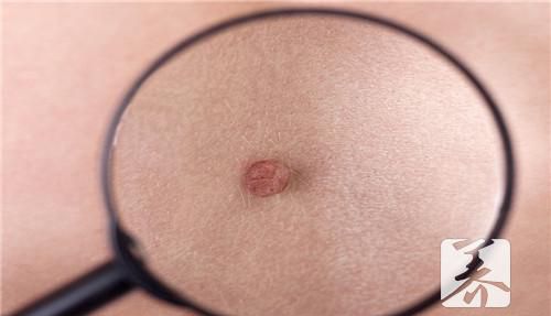 维生素e乳膏去痘印的效果