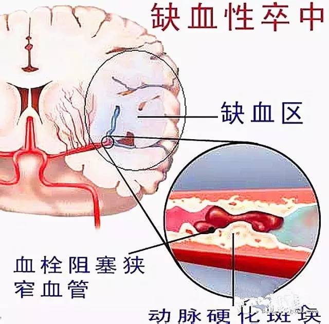 高血压导致脑梗死的原因、表现症状与处理措施