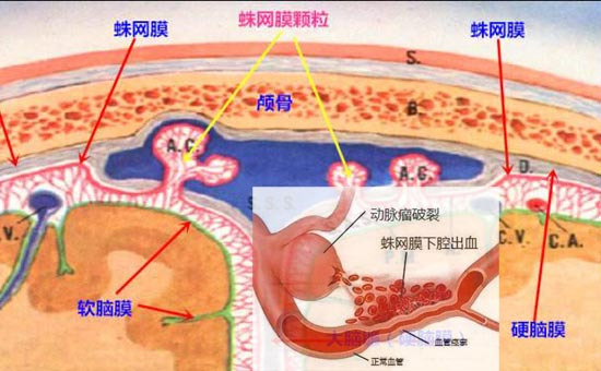 高血压蛛网膜下腔出血的原因、表现症状与处理措施