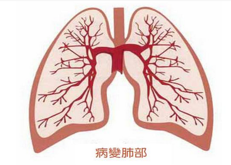 四逆汤合六君子汤加味治疗肺癌医案案例