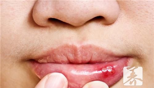 治疗口腔溃疡，6种水果被誉为“特效药”！
