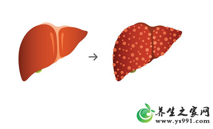 肝炎饮食注意哪些?肝炎饮食注意事项