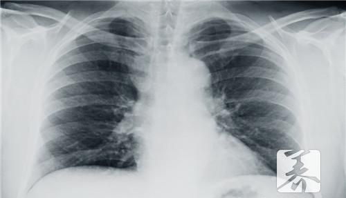 中医治疗胸腔积液的方法
